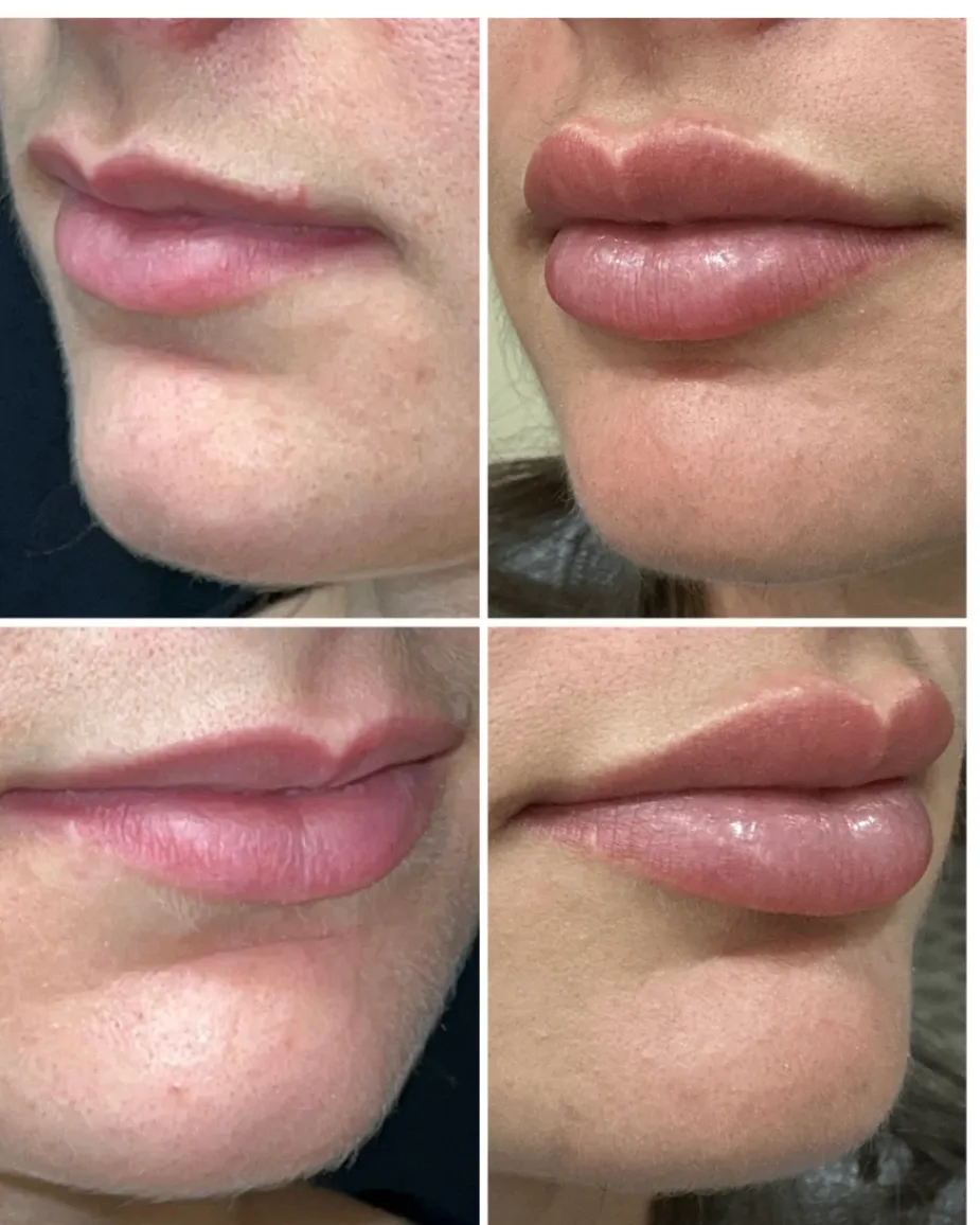 Lip treatment before-and-after collage showing subtle changes in volume and shape